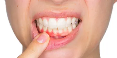 Причины возникновения флюса на десне - Лечение или удаление периостита  зубов у взрослого или ребенка | Стоматология LeoDent