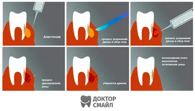 Удаление зуба при флюсе - цена от 3000 ₽ в Санкт-Петербурге | клиника  Медикор