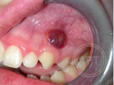 Флюс зуба | Флюс на десне: как лечить, чем полоскать, пить ли антибиотики