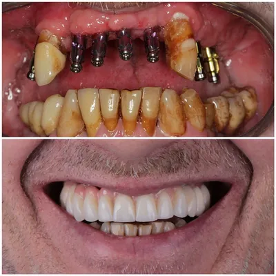 Причины флюса в Волгограде: периостит после лечения и удаления зуба .