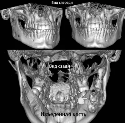 УЗИ при волосяной кисте кожи