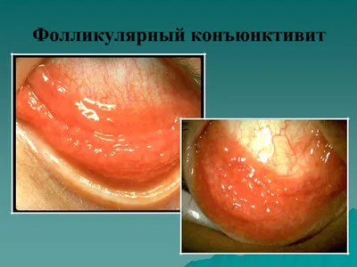 Вирусный конъюнктивит: причины, симптомы, признаки, виды, лечение