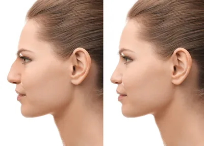 Улучшение формы носа (ринопластика) | Медицинский центр Эра