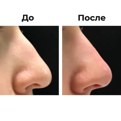 Коррекция формы носа - MV Aesthetics - Клиника эстетический медицины в Киеве
