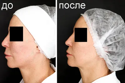 Моделирование носа | Как выбрать форму носа? | Ринопластика - YouTube
