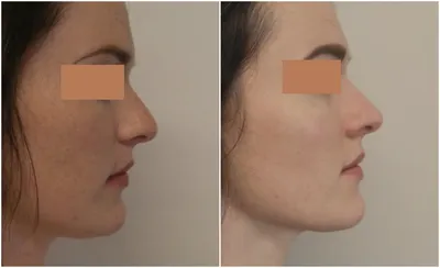 Как проблемы с кожей связаны с формой носа?