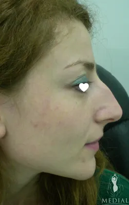 Swelll носа и глаза после операции по улучшению формы носа Стоковое  Изображение - изображение насчитывающей внимательность, больно: 52308445