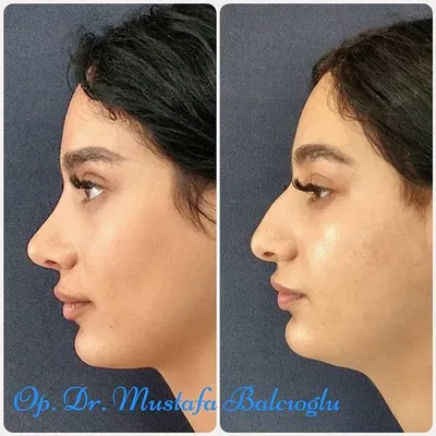 Коррекция формы носа: хирургические и безоперационные методы