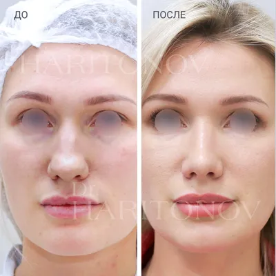Коррекция формы носа. Безоперационная ринопластика. Преображение кончика  носа с помощью инъекционных препаратов непосредственно в зону… | Instagram