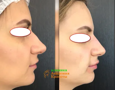 1 шт., Корректирующее приспособление для коррекции формы носа | AliExpress