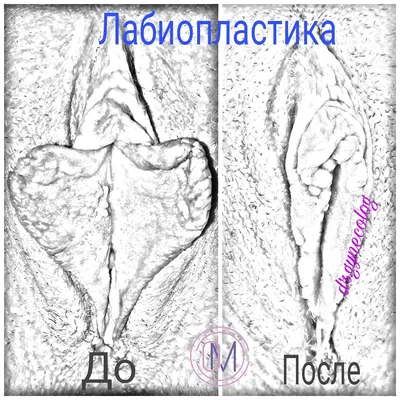 Киста половой губы: причины, симптомы, диагностика, лечение, операция в  клинике «АльтраВита»