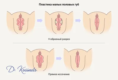 Формы половых губ фото фото