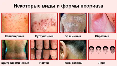 Лечение псориаза: лечение псориаза разных стадий и форм в Киеве - цены и  отзывы в клинике Оксфорд Медикал