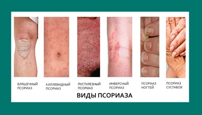 ᐈ Лечение псориаза 【Левый Берег】 Киев ~ Цены