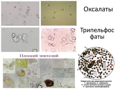 Втройне кристаллы фосфата в человеческой моче Стоковое Фото - изображение  насчитывающей аналитиков, триппель: 66656660