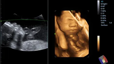 УЗИ 3D и 4D при беременности – Другие методы диагностики – диагностическое  отделение в МЦОЗ