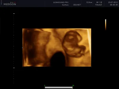 3D/4D УЗИ во Время Беременности в медицинском центре «Тонус» в Истре
