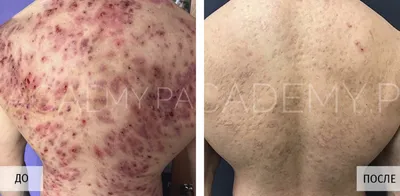 До и после лечения акне- это не только разница в здоровье кожи. Изменения  происходят во всем! Мои пациенты становятся открытыми… | Instagram