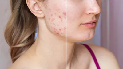 Лечение акне: до и после | Косметолог Елена Умнова | Дзен