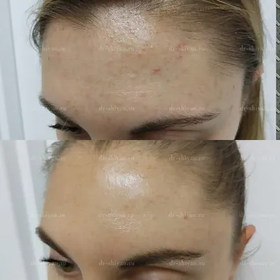 Акне на лице лечение фото до и после. Акне фото после лечения. Акне до и  после лечения фото.