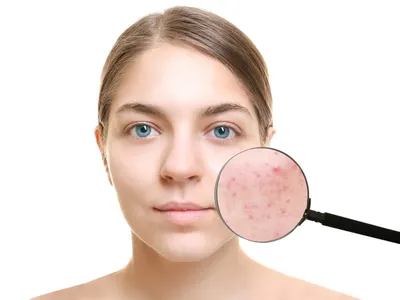 Прыщи на щеках у женщин: причины появления, как избавиться от акне и угрей,  лечение в косметологической клинике