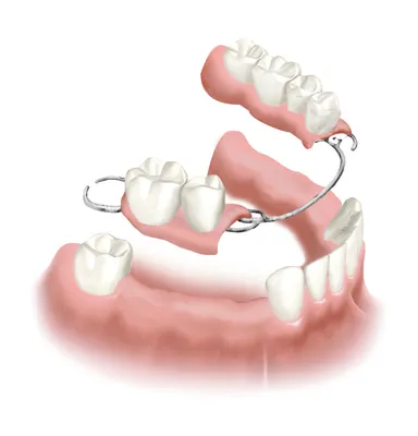 Бюгельные зубные протезы на верхнюю и нижнюю челюсть [виды и цены]