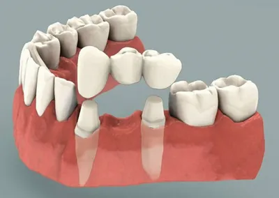 Бюгельные протезы в Оренбурге по цене от 6 000 ₽ | стоматология Вита-Дент