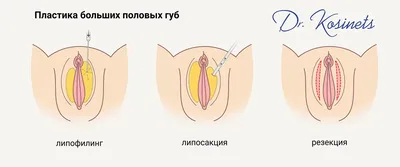 До / После — Липофилинг (увеличение) больших половых губ — Москва