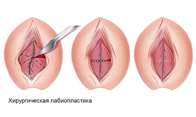 Липофилинг больших половых губ | Пластический хирург Кондратьев Д.Г.