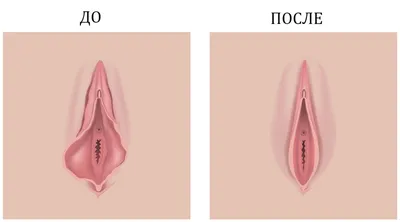 Липофилинг (увеличение) больших половых губ — Москва