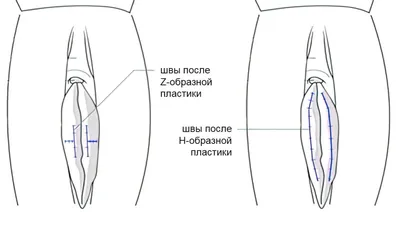 Лабиопластика - цена операции по пластике больших и малых половых губ в  Москве | АльтраВита