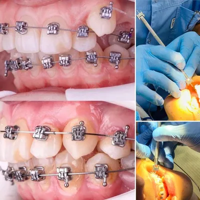 Металлические брекеты: цена, виды систем, установка | НоваДент