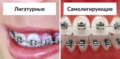 Самолигирующие брекет системы — ОртоСмайл — стоматология для всей семьи