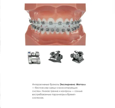 Чистка брекетов [уход за брекетами после установки]