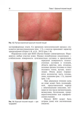 Случай №27. Красный плоский лишай 2.0…или месяц на коже. | Сайт  дерматовенеролога Бетехтина М.С.