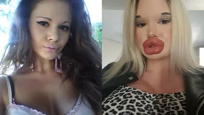 Накаченные губы до и после - 74 фото