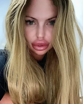 Как выглядят самые большие губы в мире: 8 девушек, переборщивших с  филлерами гиалуроновой кислоты