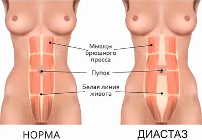 Ушивание диастаза прямых мышц живота: цена операции - Убрать диастаз в  клинике СПб