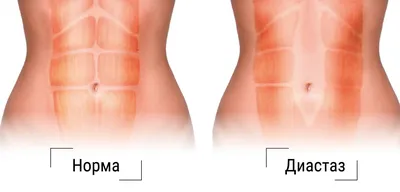 Диастаз прямых мышц живота с пупочной грыжей. Как устранить проблему,  рассказывает хирург, кандидат медицинских наук, доцент Александр КАРМАН -  Медицинский центр «Нордин»