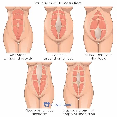 Чем плох диастаз живота для женщин?