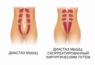 Диастаза живота. Что делать для его устранения? - Исамутдинова Г. М.