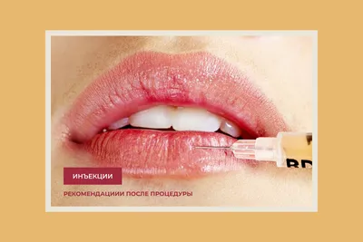 Гиалуроновая кислота Juvederm Ultra 3 - «Фото-дневник первого увеличения  губ: ощущения и результаты по дням! Стоит ли оно того? Ассиметрия губ. Фото  ДО, ПОСЛЕ, спустя 5 месяцев.» | отзывы