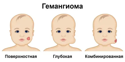 Удаление гемангиомы и винных пятен в Киеве. Цена - Coolaser Clinic