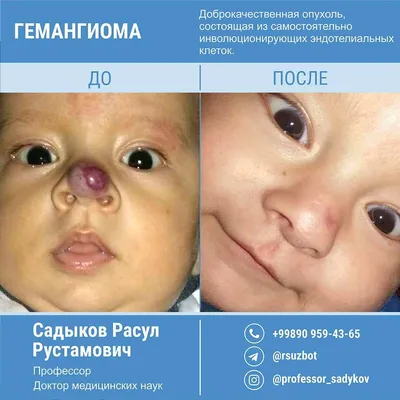 Лазерное удаление гемангиом у детей