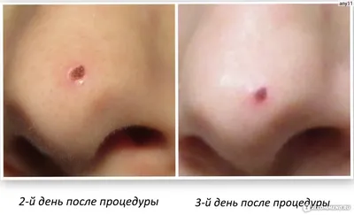 Фото до и после лазерной косметологии | Клиника Damas Clinic на Таганской