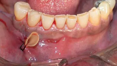 Дренаж в десне: как выглядит (фото) и что делать если выпал | Dental Art