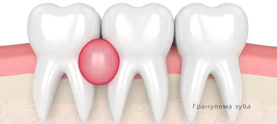 Лечение флюса не десне по недорогой цене в Екатеринбурге. Удалить флюс на  щеке в стоматологии Приоритет