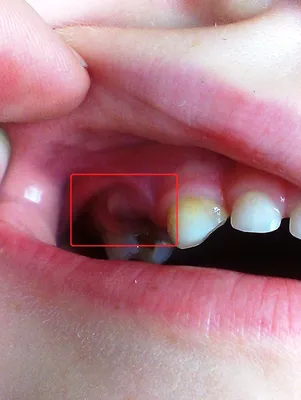 Резекция верхушки корня зуба, цена в Москве в стоматологии Smile-at-Once