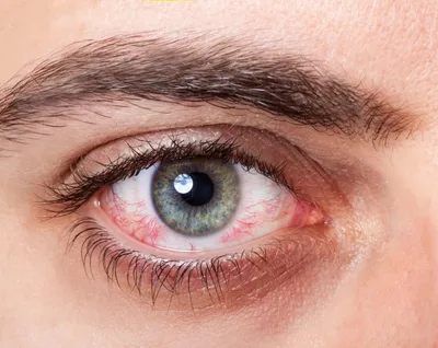 Синдром сухого глаза: симптомы, причины, лечение | РБК Стиль