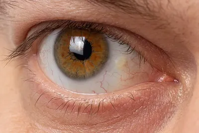Разрыв сетчатки глаза - причины, симптомы, лечение